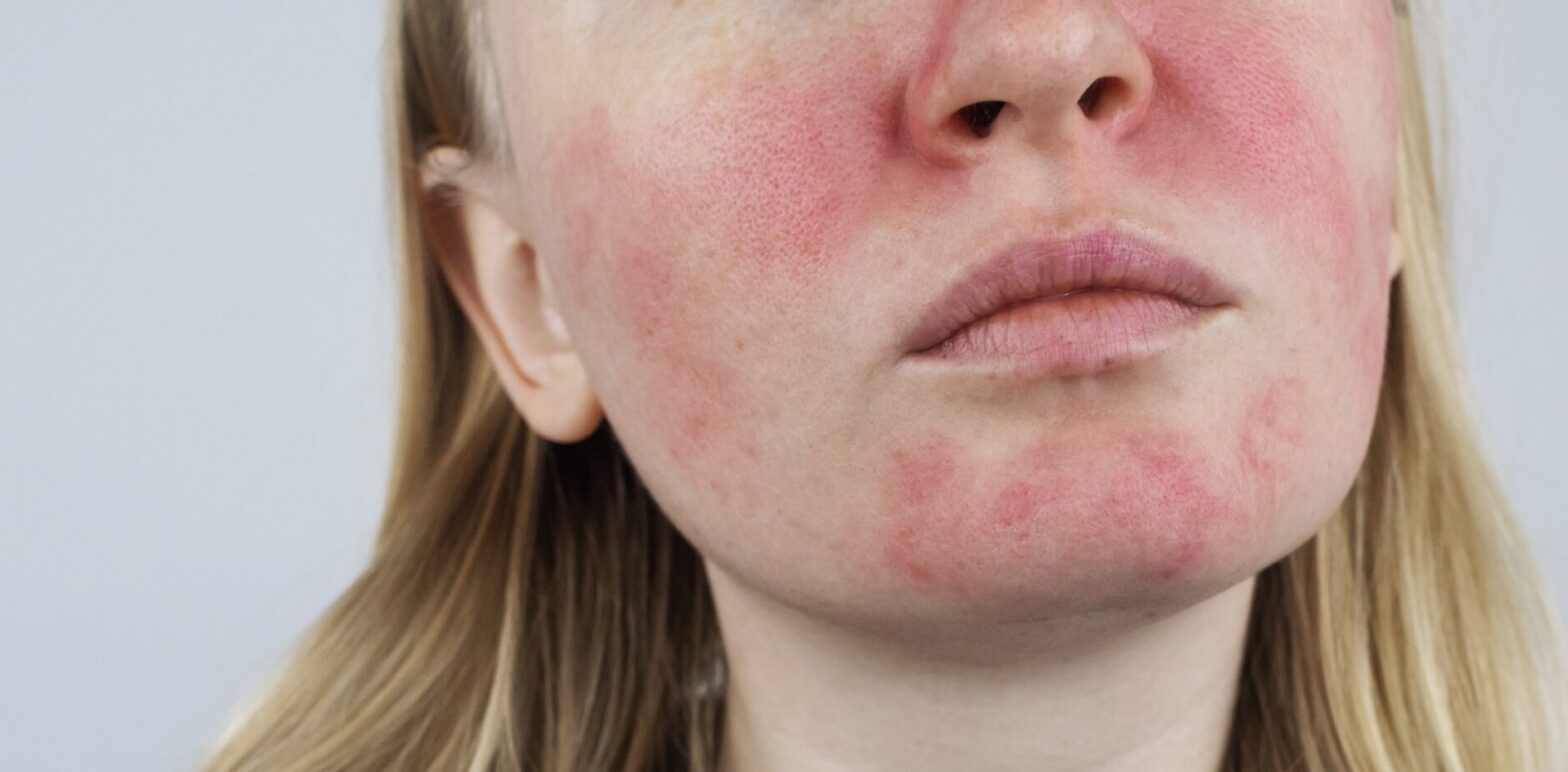 rosacea treatments