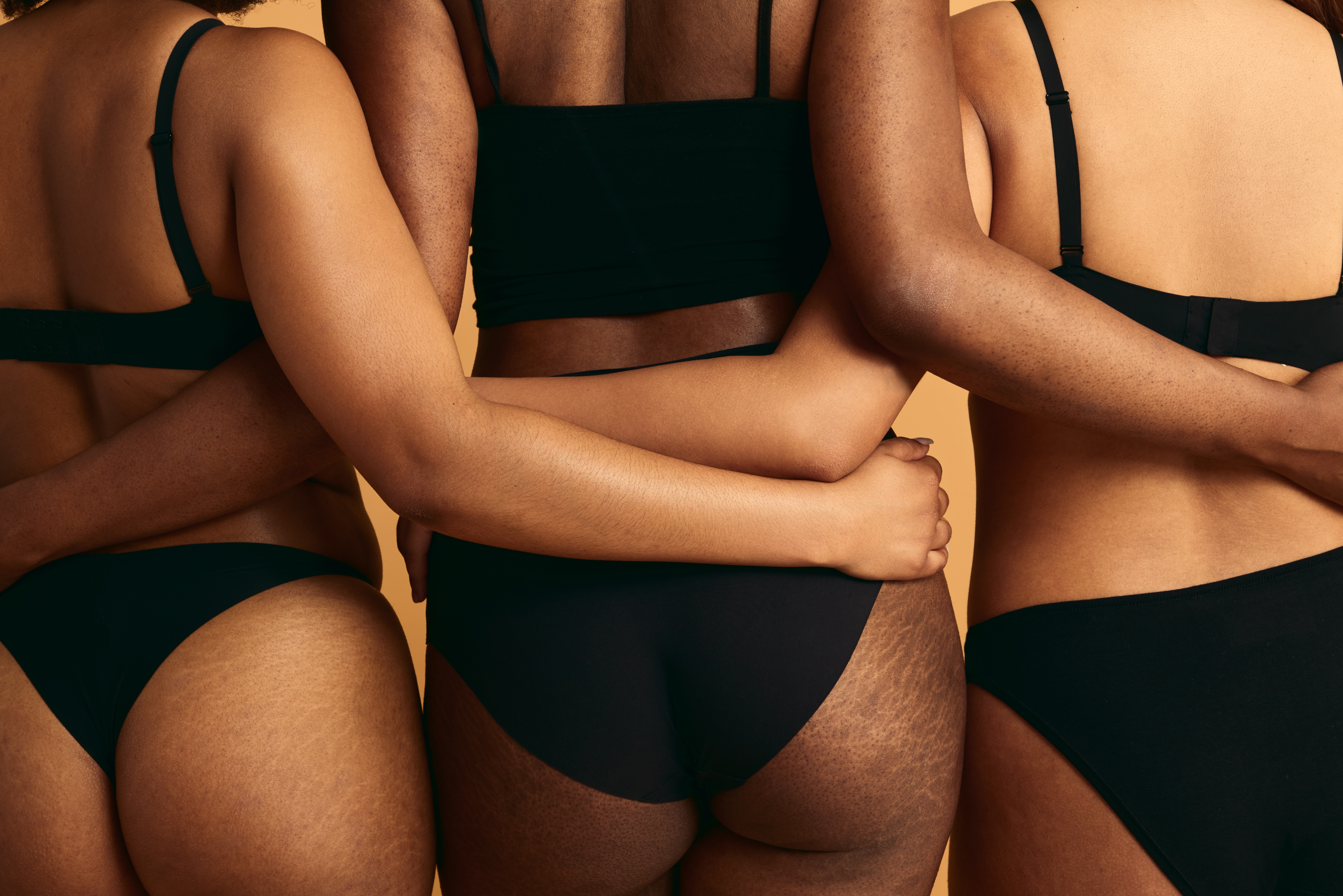 Stretch Marks 101: Understanding, Preventing, and Treating Them