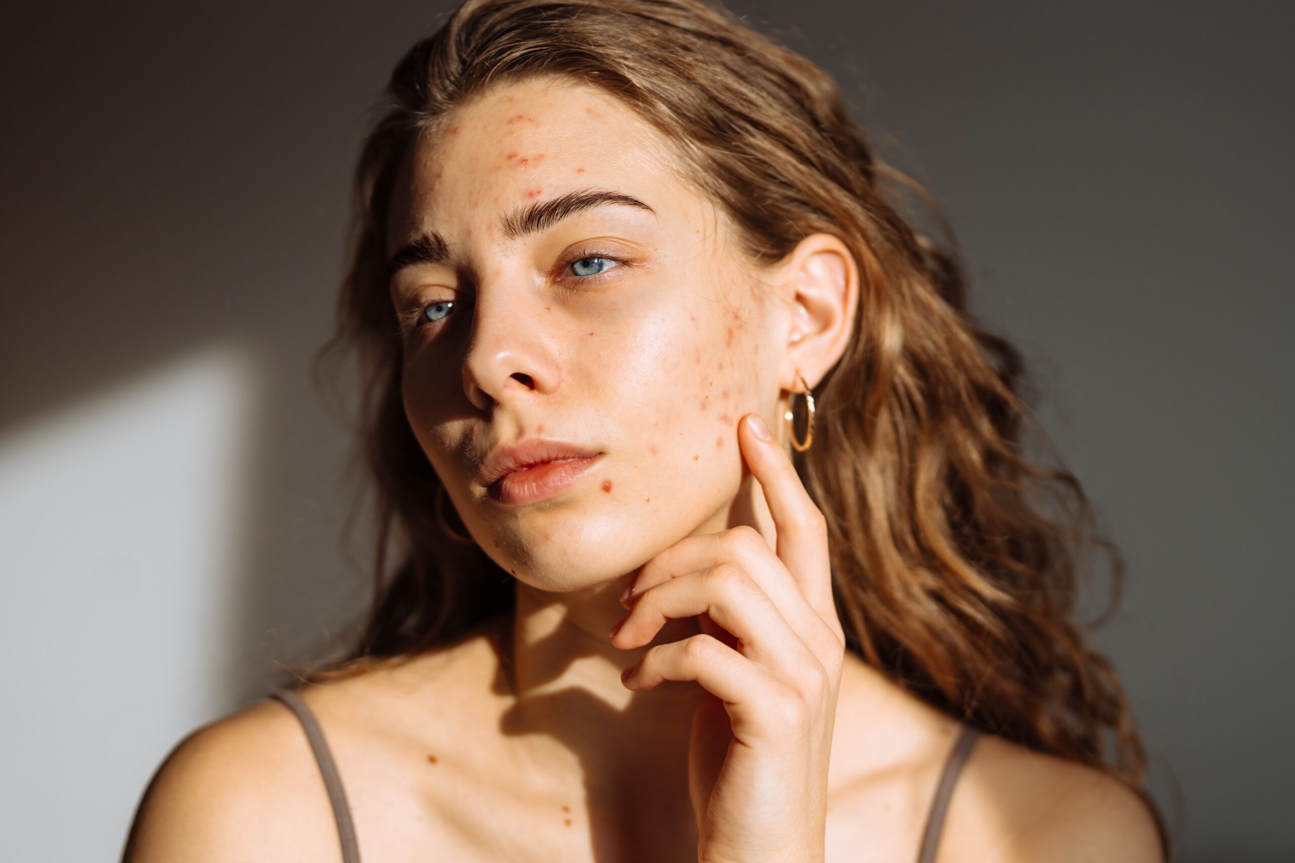 Understanding Acne: Causes, Concerns, and Advanced Treatment Options