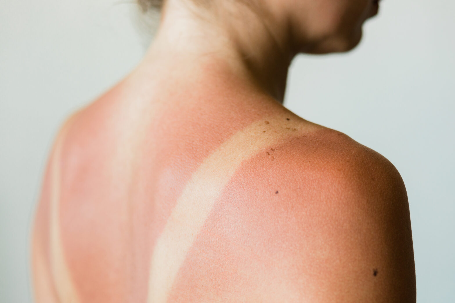 sunburn