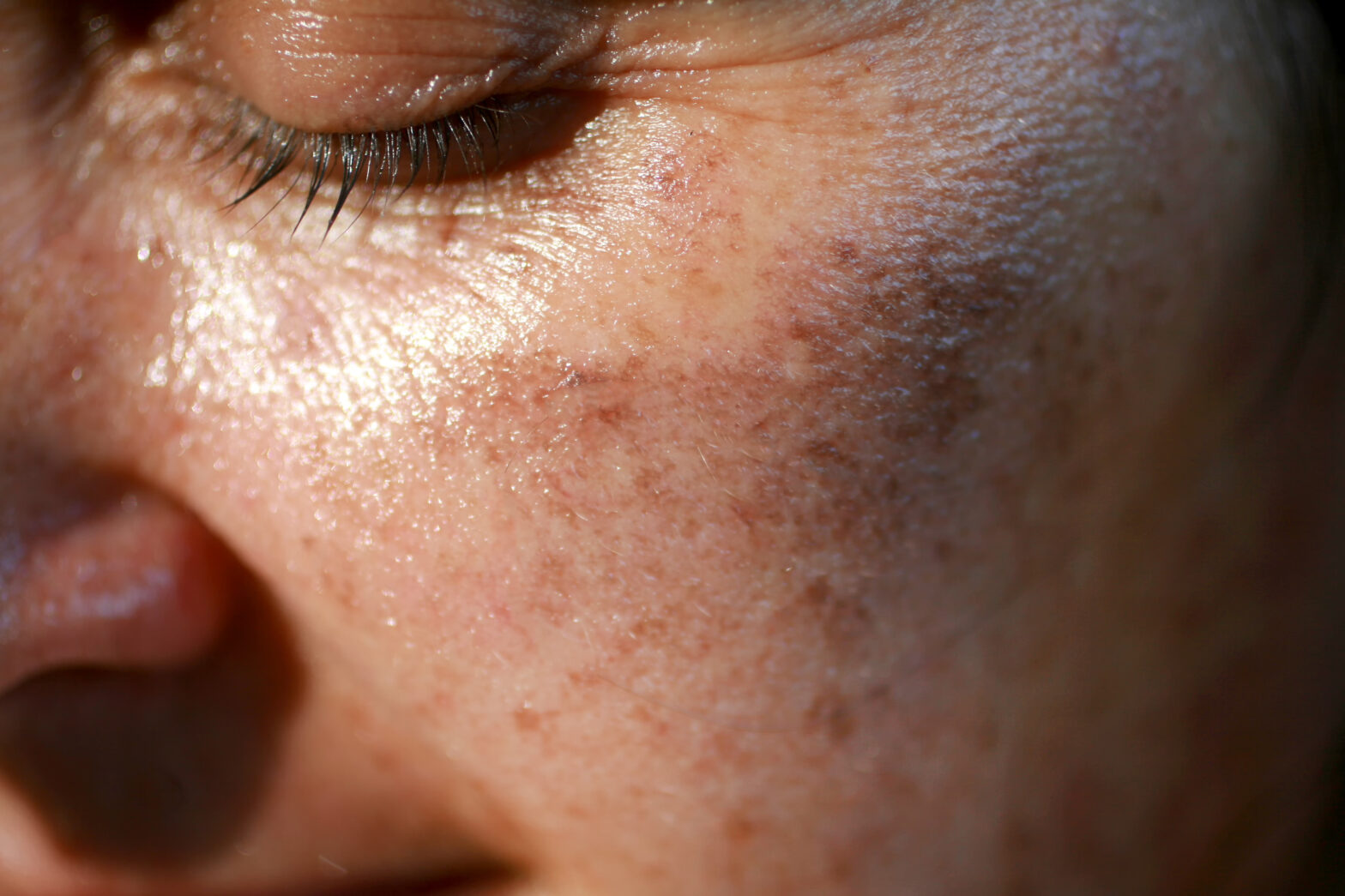sun damage