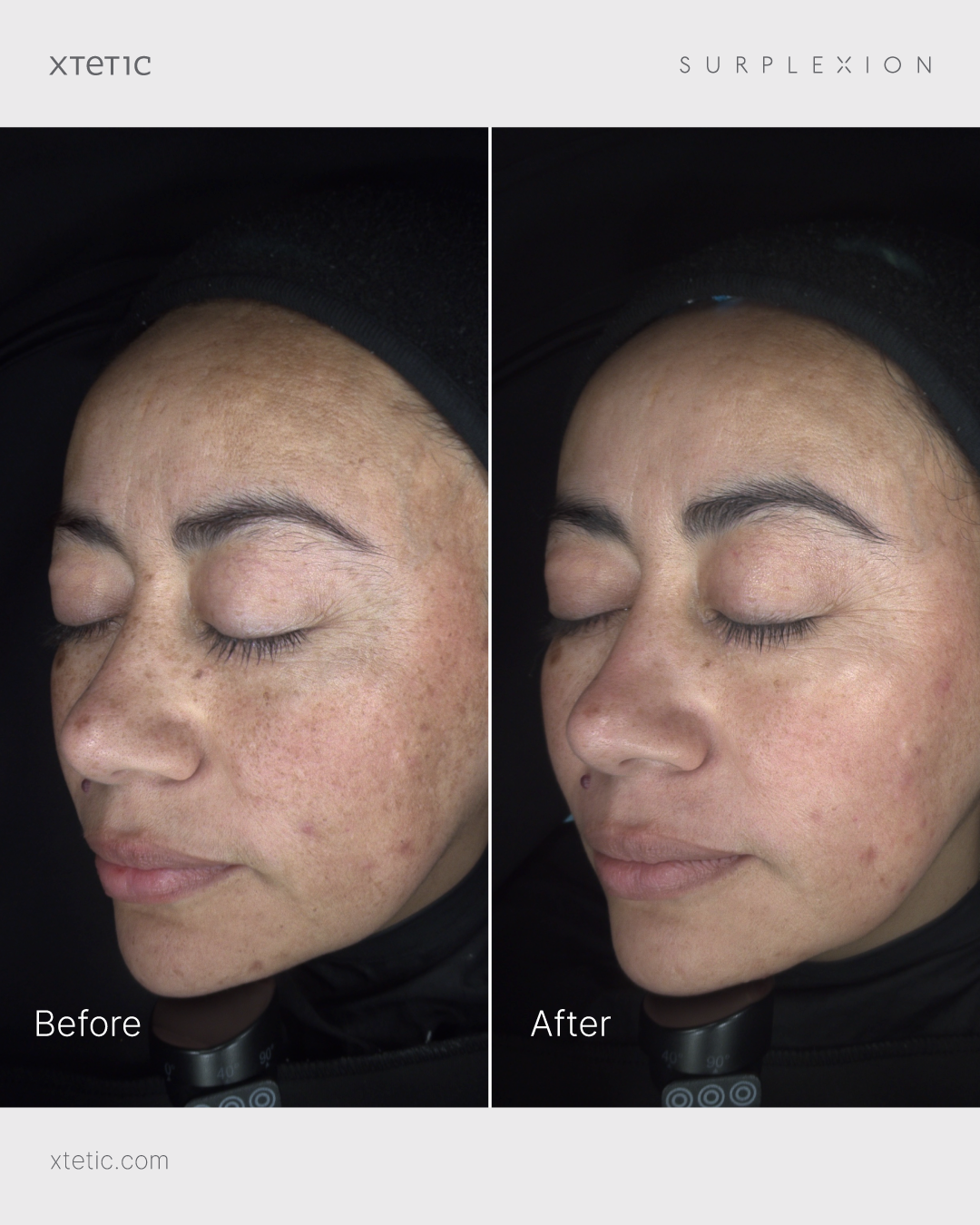 Surplexion 101 Before After Combined Image