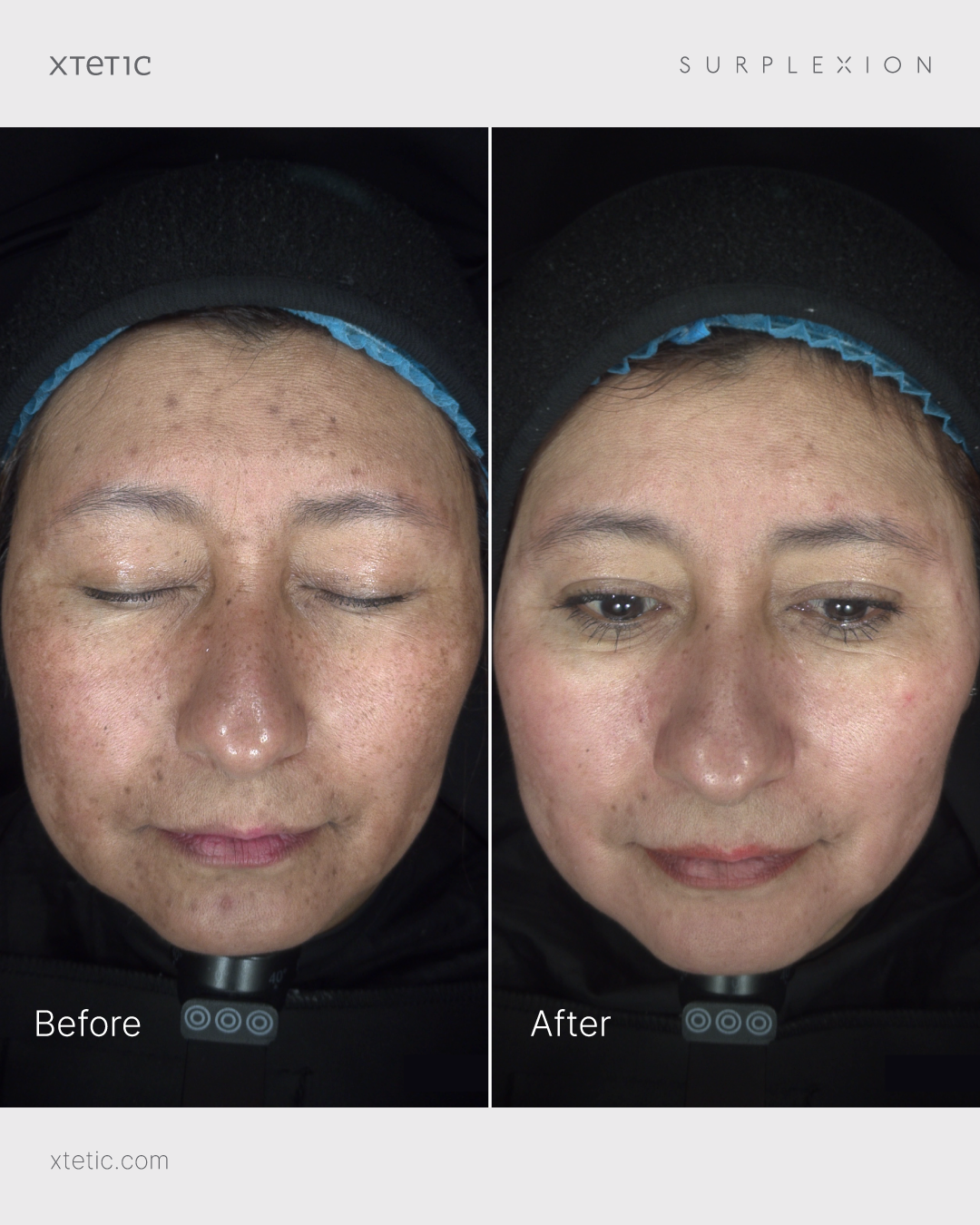 Surplexion 100 Before After Combined Image