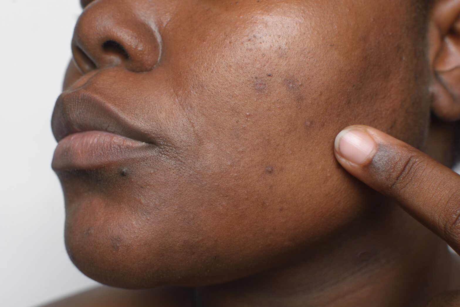hyperpigmentation