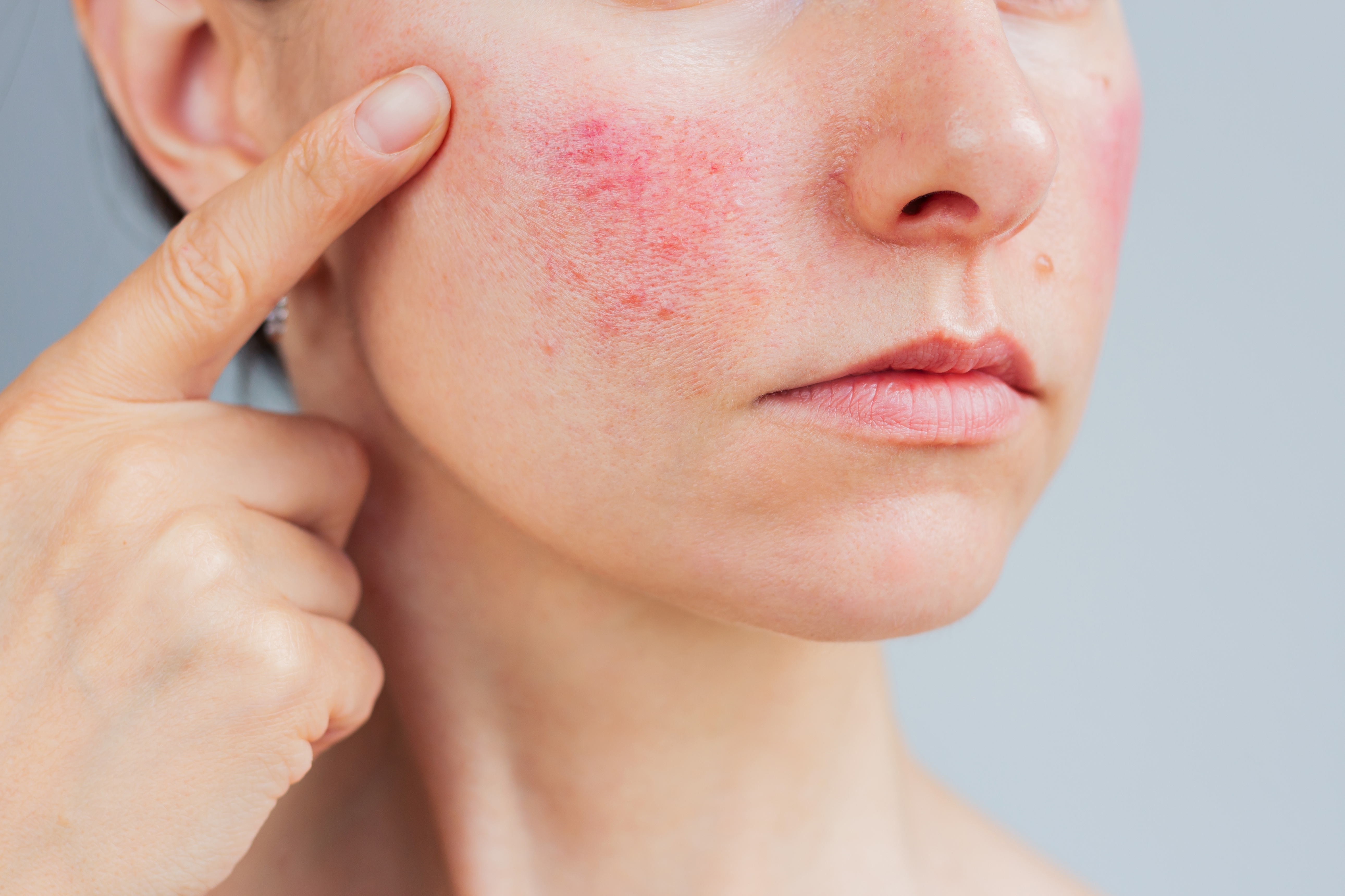 Rosacea Awareness Month: Causes and Treatments