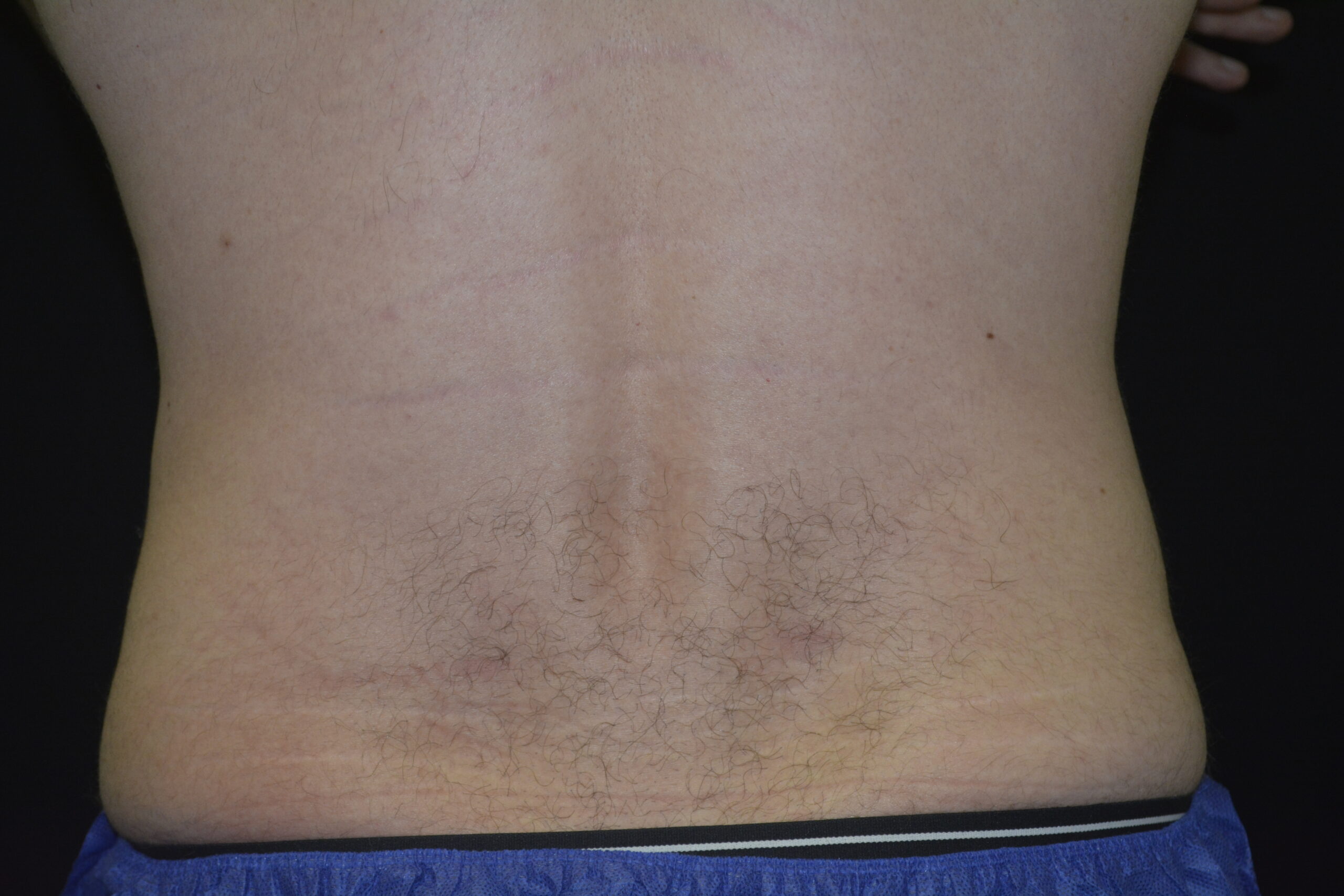 Coolsculpting 13 After Image