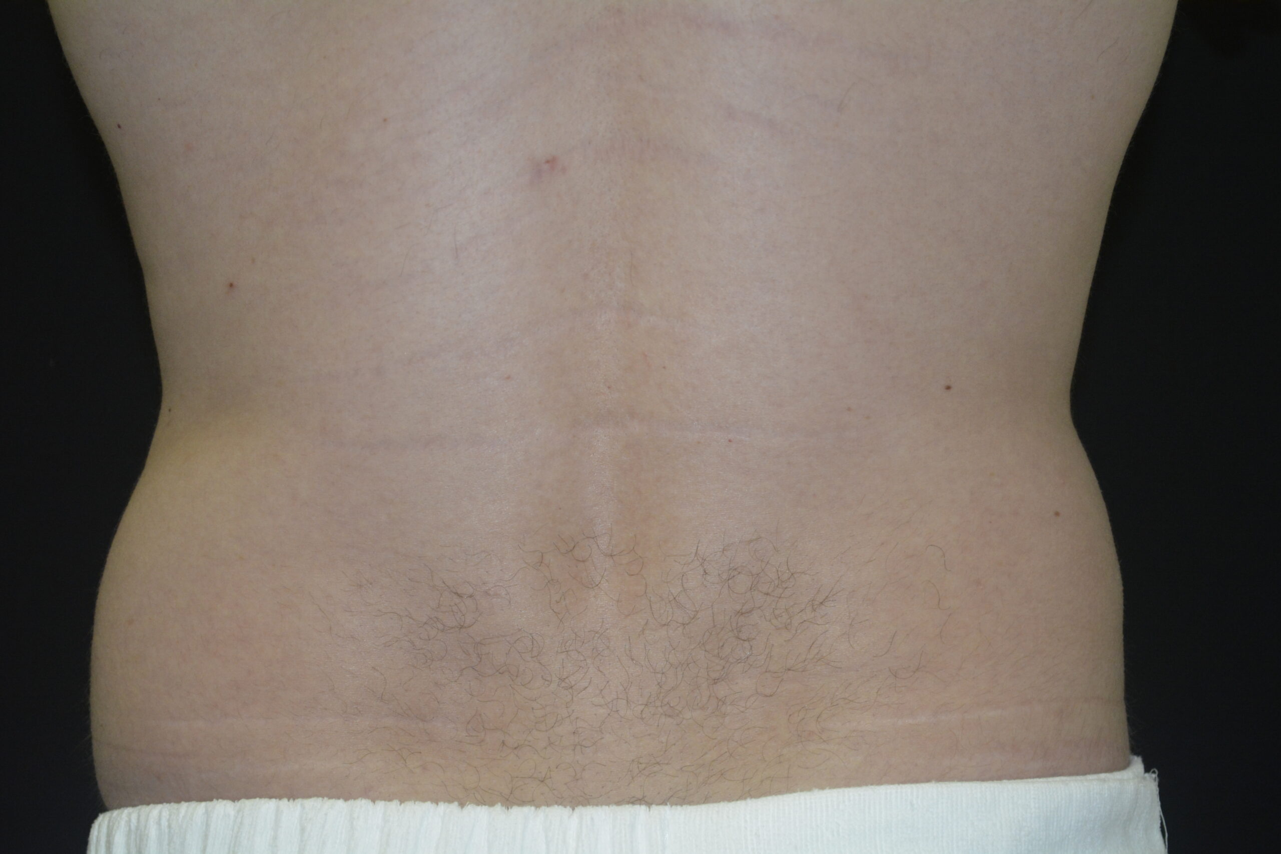Coolsculpting 13 Before Image