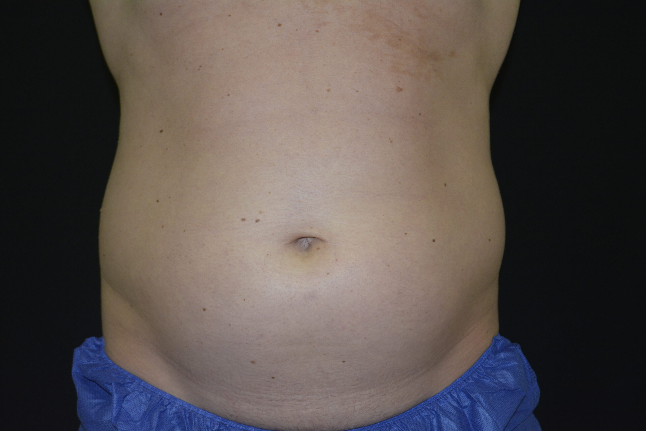 CoolSculpting #14 Before Image